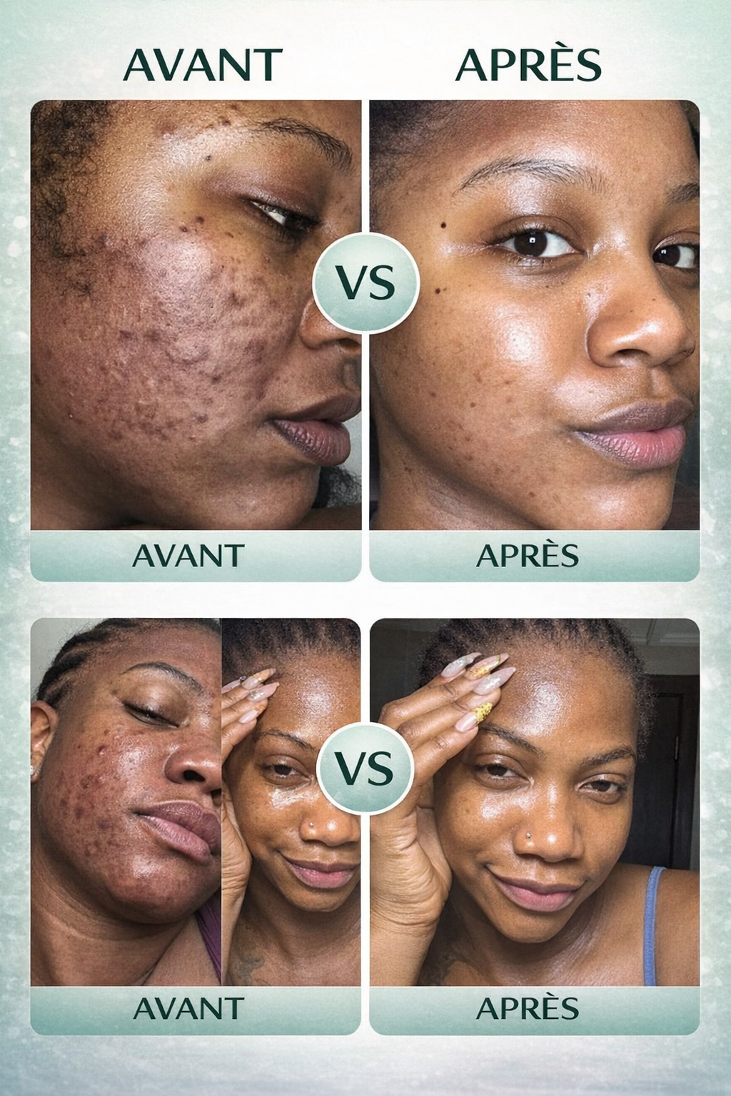 Kit Anti-Acné 30 Jours Tea Tree & Acide Salicylique – Routine Complète Peau Nette